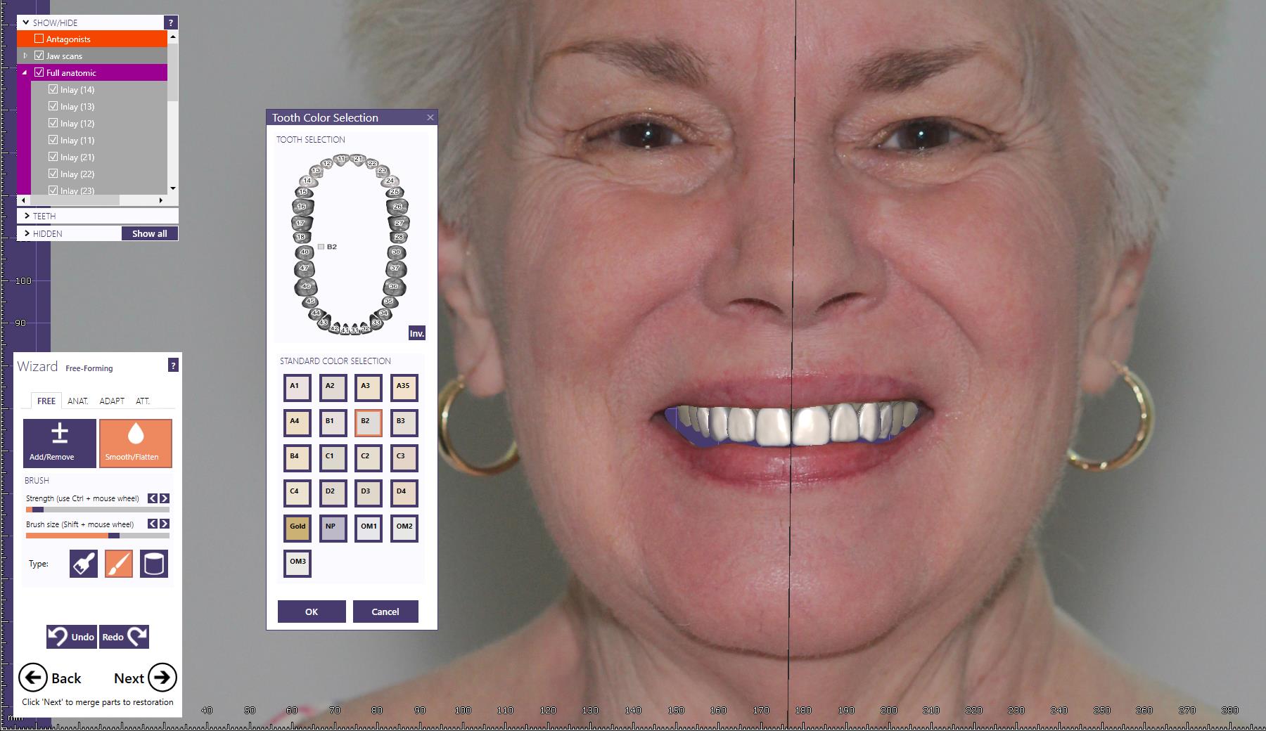 Dental News Digital facebow transfer technique dentofacial analyser