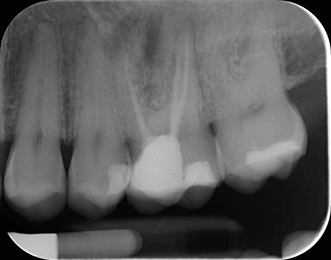 Fig. 1a : Radiographie pré-opératoire d’une molaire maxillaire (16) présentant une lésion apicale sur la racine mésio vestibulaire. Le retraitement a consisté à éliminer le matériau présent dans les canaux, récupérer la perméabilité du canal de la racine MV et gérer la fausse route faite lors du traitement précédent.