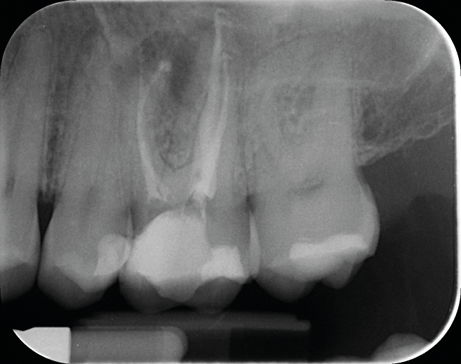 Fig.1b : La radiographie post-opératoire objective une atteinte des objectifs techniques (obturation Bioroot RCS (Septodont). 