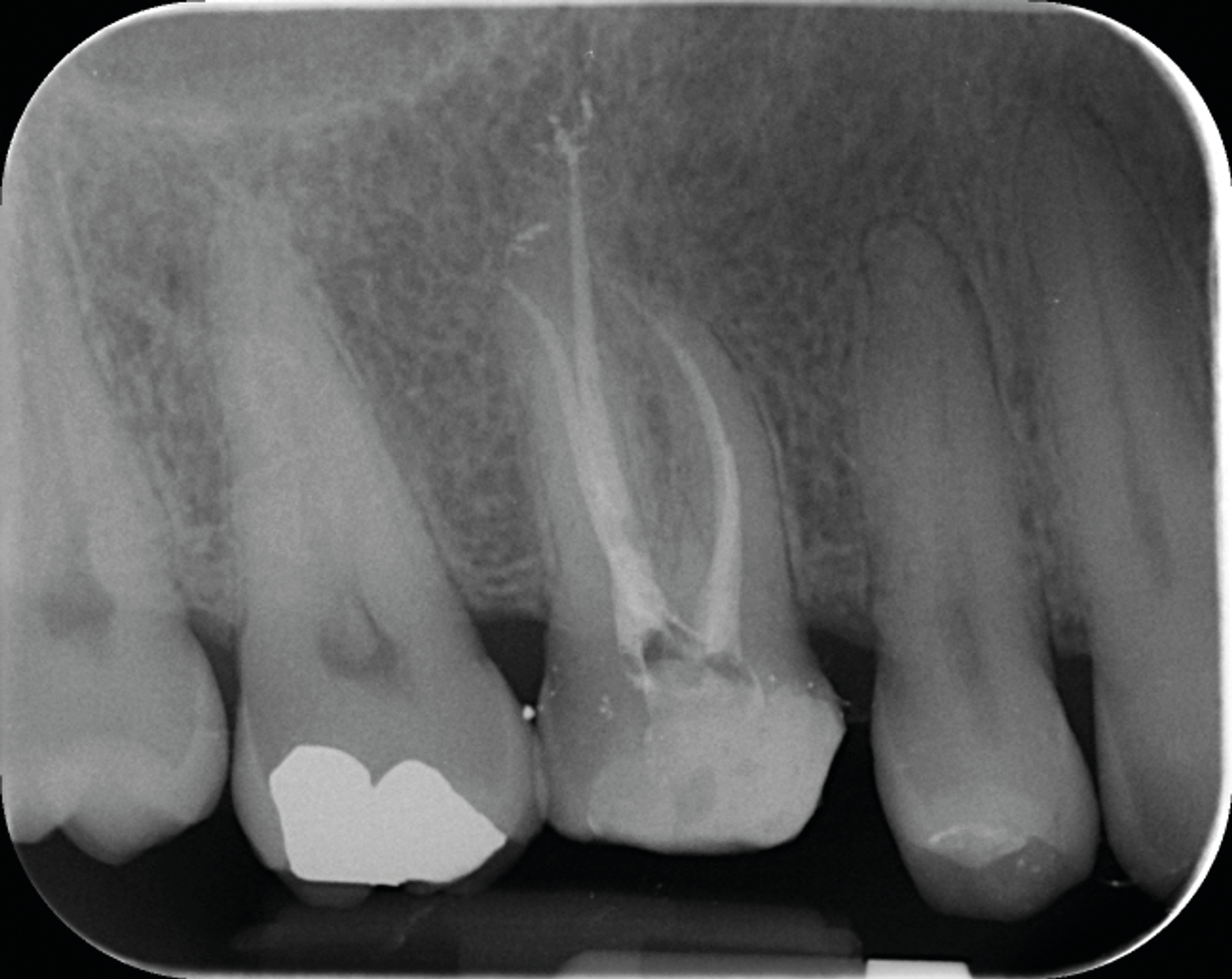 Fig. 6a : Exemple de traitement canalaire réalisé avec des instruments et techniques d’obturation de dernière génération : (a) radiographie préopératoire d’une molaire maxillaire présentant une nécrose pulpaire,...