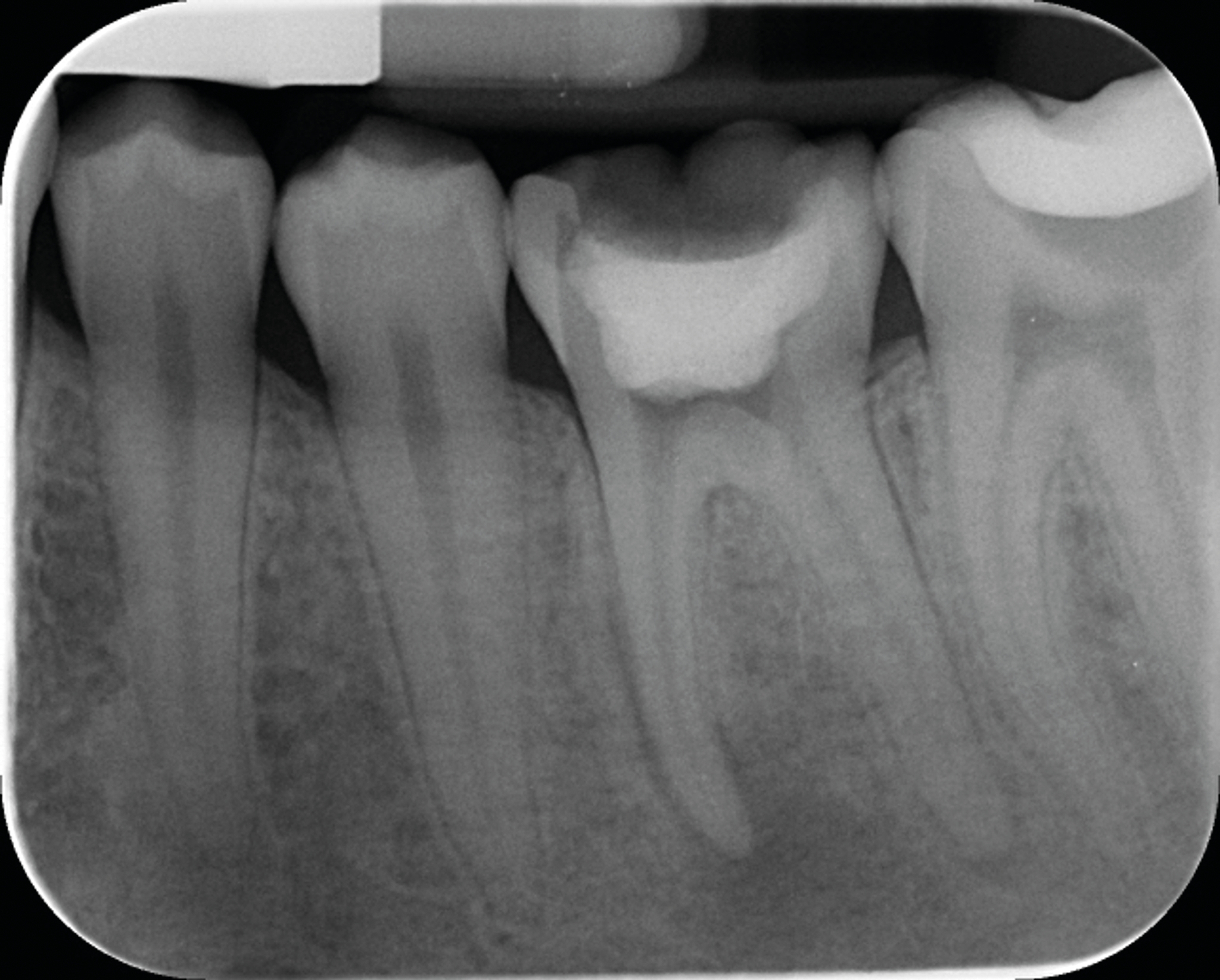 Fig. 7a : Traitement canalaire d’une molaire mandibulaire réalisé avec le système SlimShaper (Zarc – Endoboutik) et obturation avec le CeraSeal (Komet). (a) Radiographie préopératoire, ...