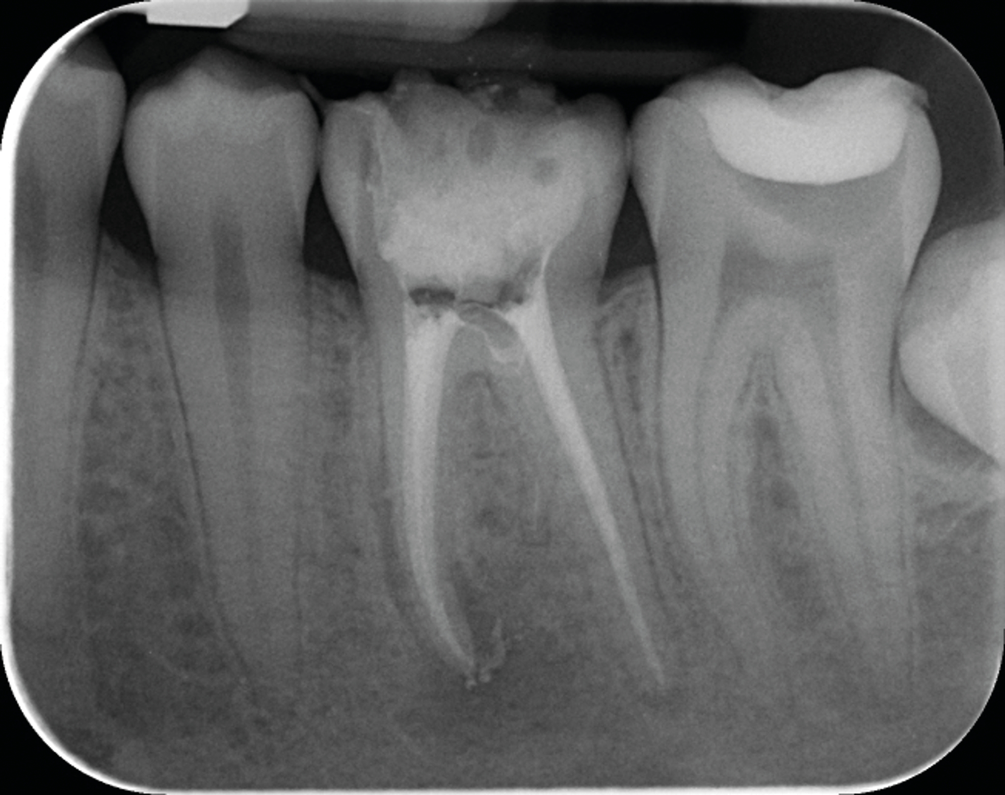 Fig. 7b : ...radiographie postopératoire mettant en évidence la préservation maximale de tissu dentaire dans la partie cervicale de la dent, grâce au système SlimShaper. Cette mise en forme préservatrice n’a pas interféré sur le reste de la procédure, elle permet surtout d’éviter d’affaiblir la dent dans la zone cervicale.